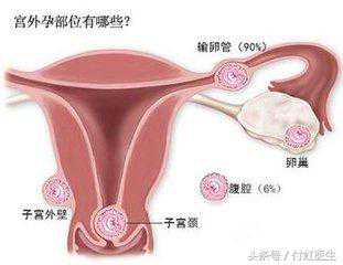 因为宫外孕切除了一根输卵管，还能怀孕吗？
